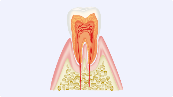 虫歯の初期