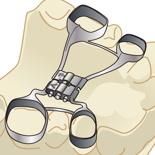 拡大床 子供の顎の成長を促す矯正 中野の歯医者 歯科 いぐみ歯科 矯正歯科