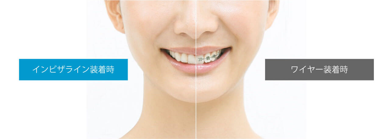 インビザライン矯正について 中野の歯医者 歯科 いぐみ歯科 矯正歯科