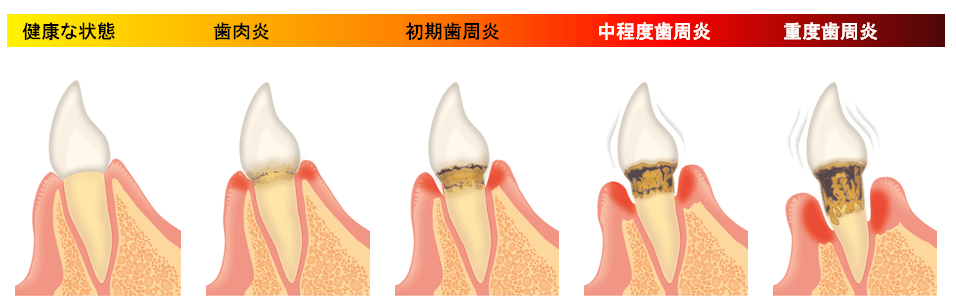 歯周病の段階