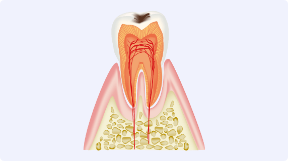 歯の表面（エナメル質）に小さな穴が空く