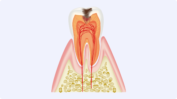 歯に穴が空き、象牙質まで進行