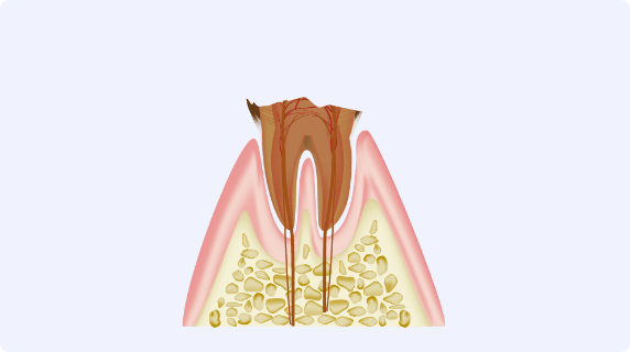 歯の根まで虫歯が進行している