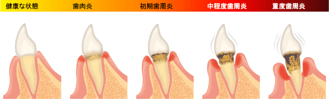 歯周病の進行段階