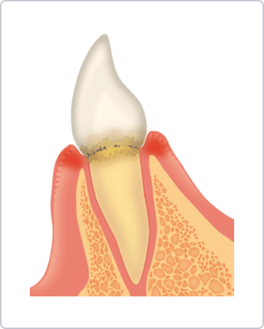 歯肉炎