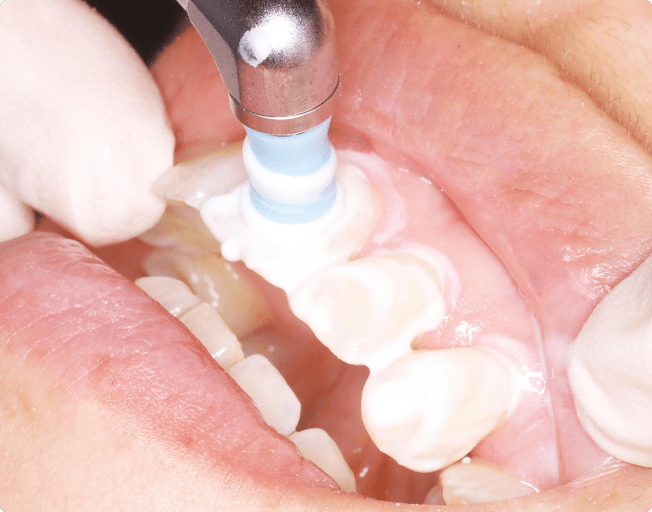 歯質の強化