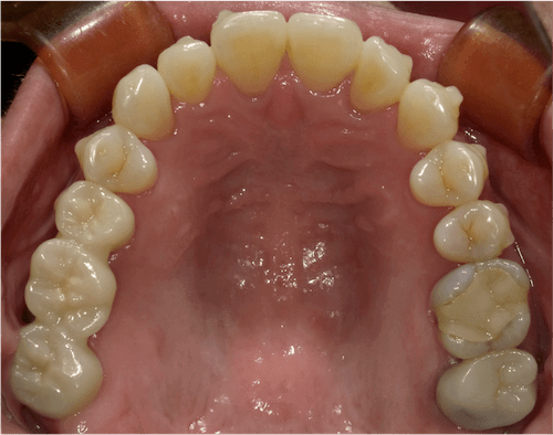 インビザラインで叢生を改善した例　術後上