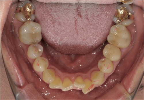 インビザラインで叢生を改善した例 術前下