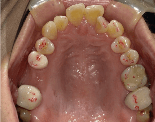インビザラインで叢生を改善した例　　術中上