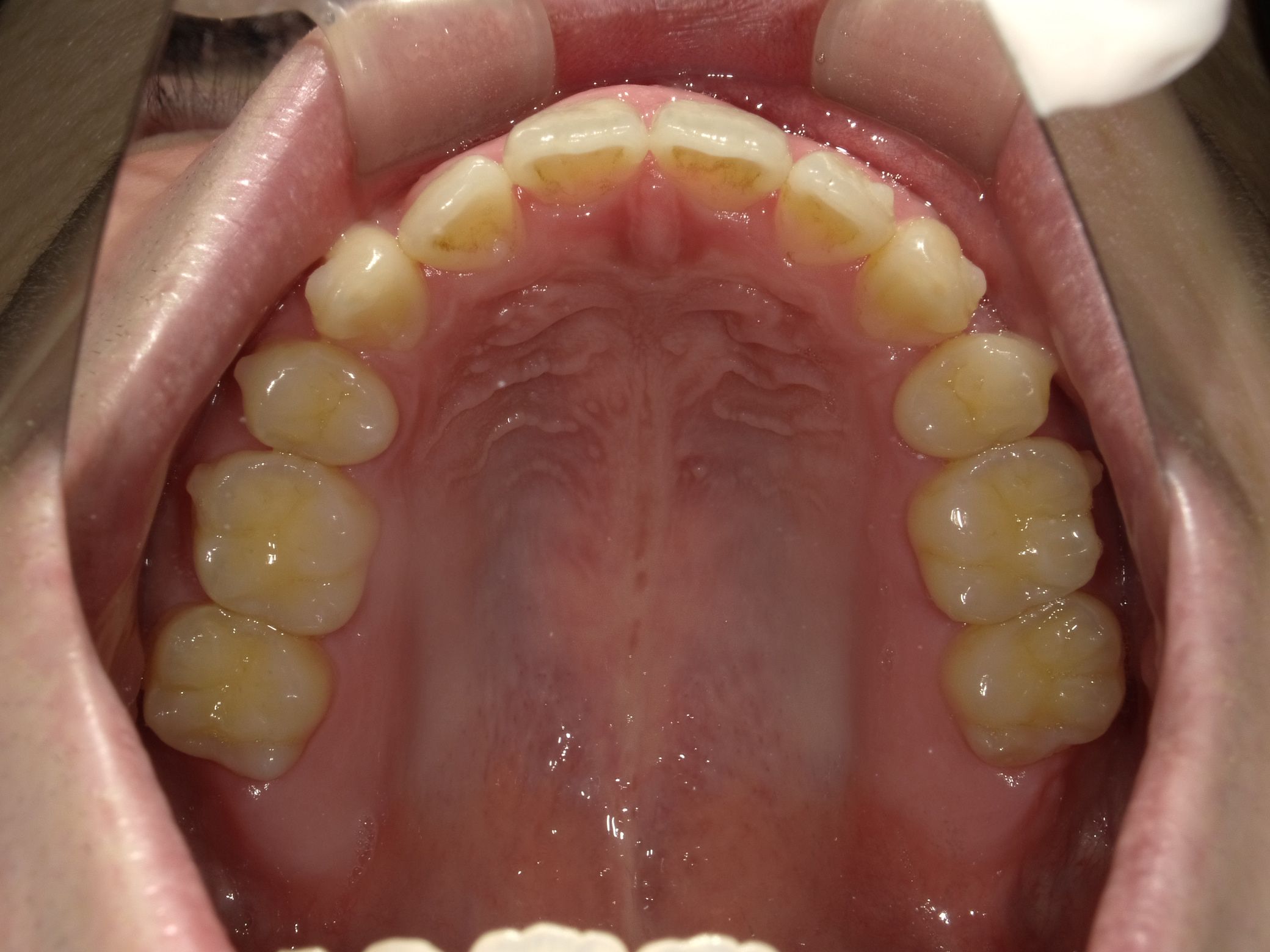 インビザラインで叢生を改善した例 術前下
