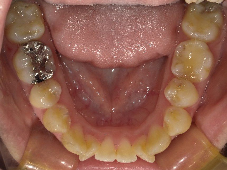 インビザラインで叢生を改善した例　　術前　左