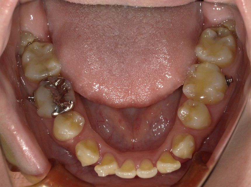 インビザラインで叢生を改善した例　　術前　左