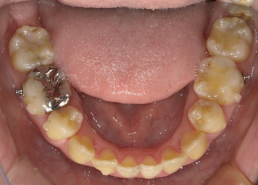 インビザラインで叢生を改善した例　　術前　左