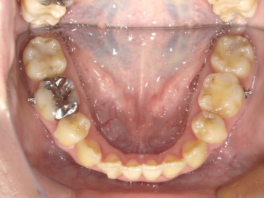 インビザラインで叢生を改善した例　　術前　左