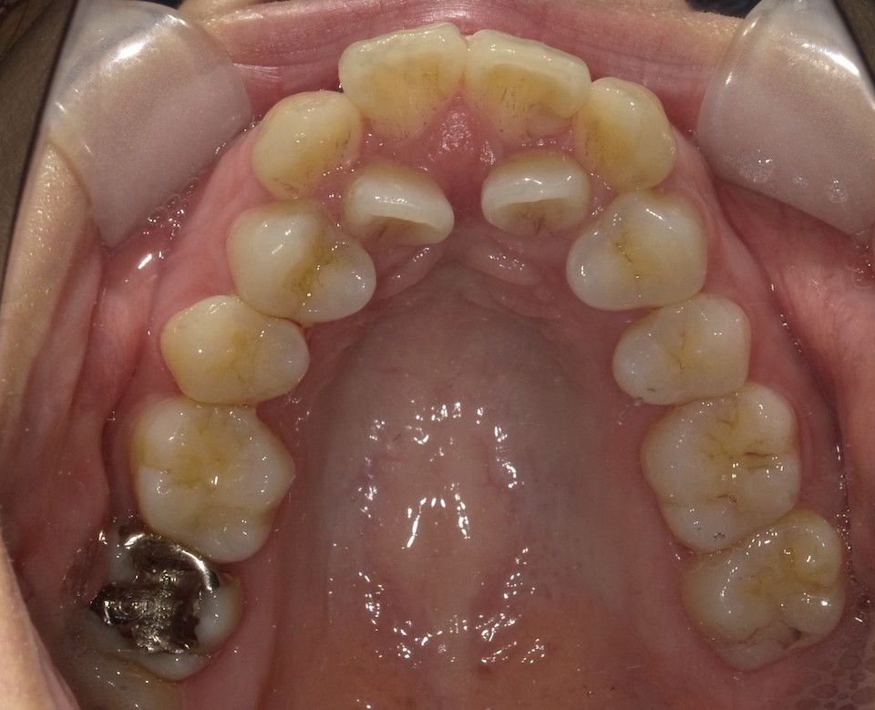 インビザラインで叢生を改善した例　術前上