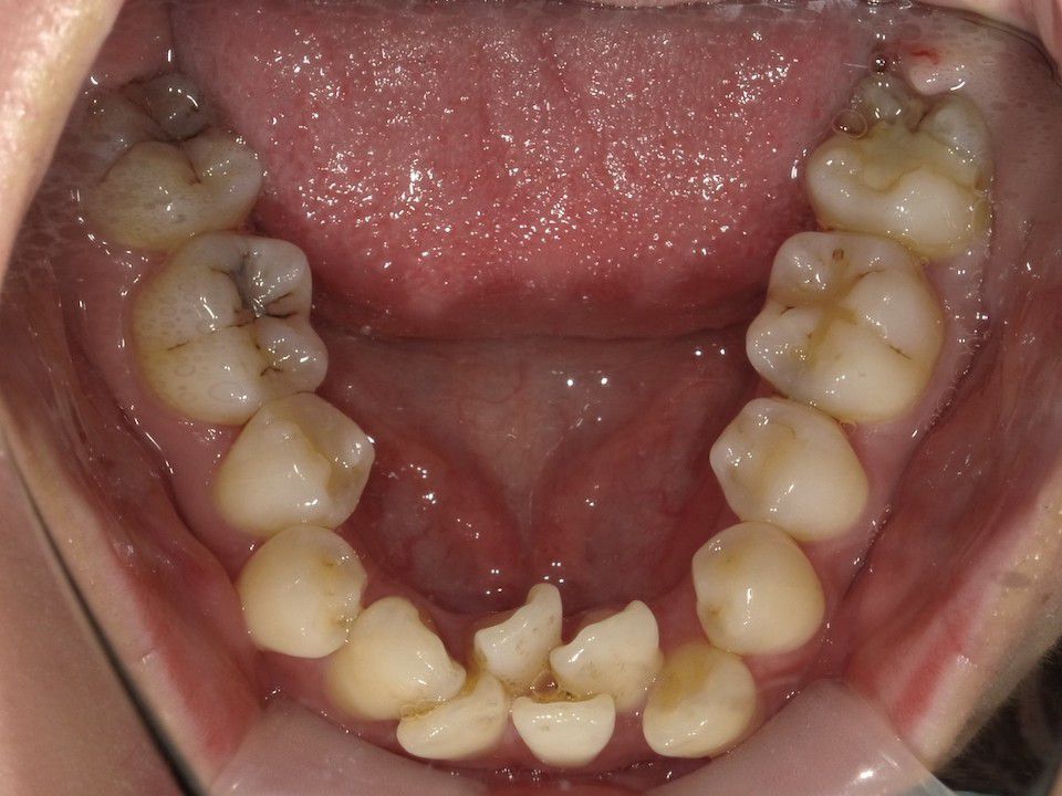 インビザラインで叢生を改善した例　　術前　左
