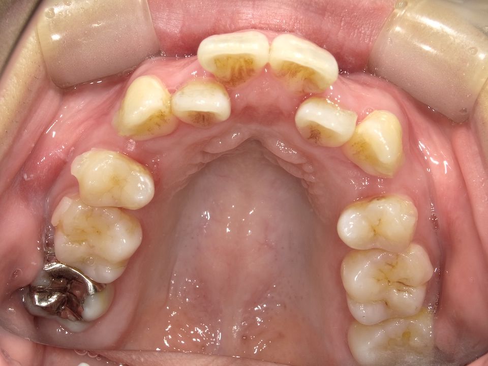 インビザラインで叢生を改善した例　術前上