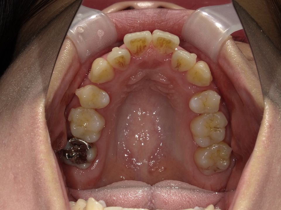 インビザラインで叢生を改善した例　術前上