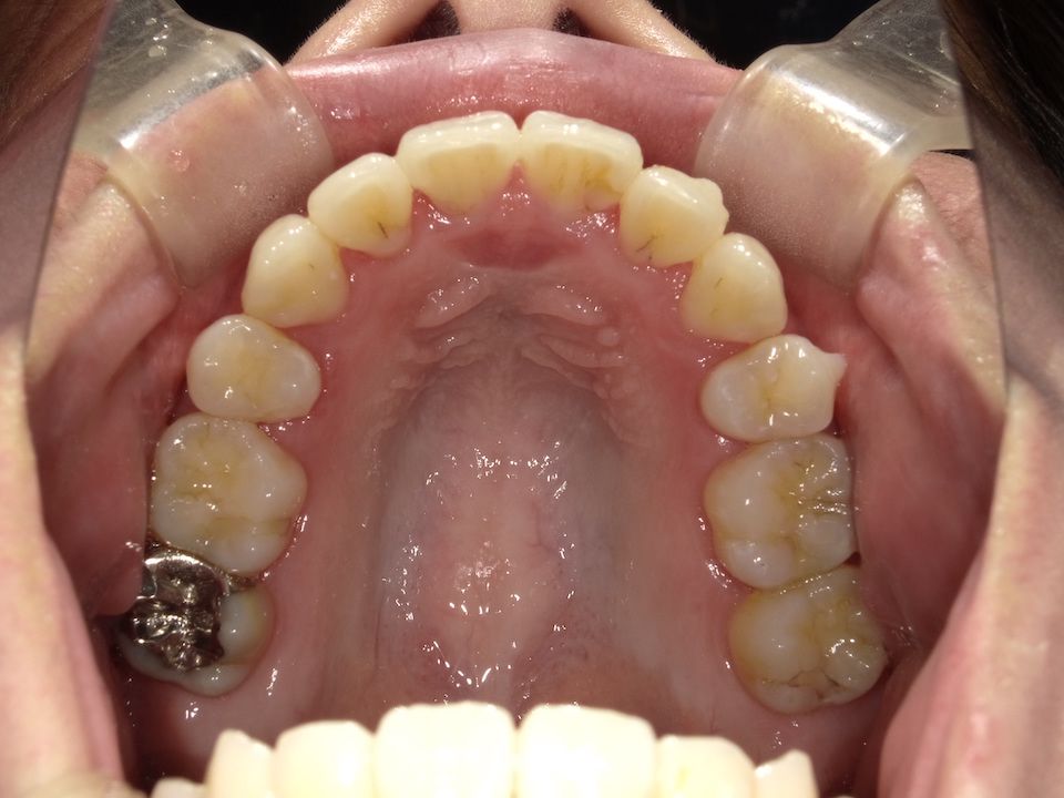 インビザラインで叢生を改善した例 術前下